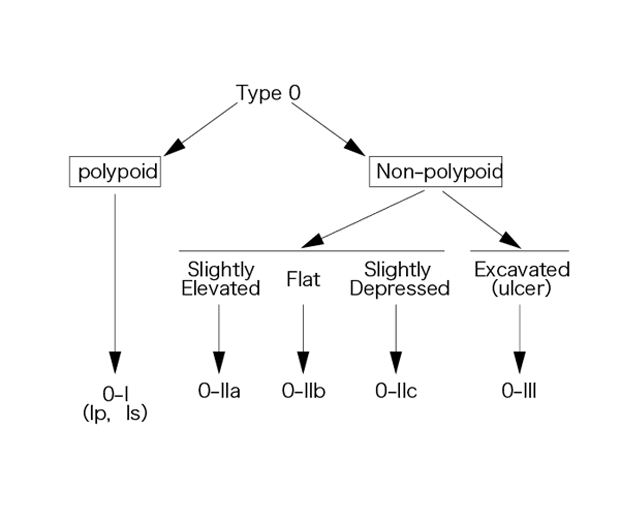 Fig. 1　表在型（Type 0）腫瘍の肉眼分類型
　〔文献1）より転載〕