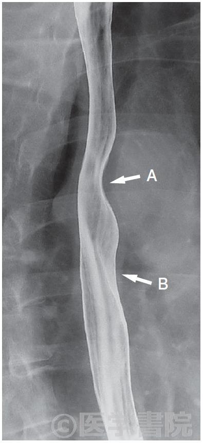 Fig. 3　生理的第2 狭窄部のX線像．
 矢印A : 大動脈弓による圧排，矢印B : 左主気管支による圧排．