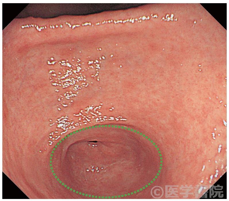 Fig. 7　胃内ランドマークとしての偽幽門輪（緑円部）．胃内には偽幽門輪を含めたランドマークがあり，解剖学的位置を同定する際には重要である．
