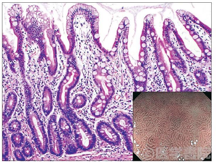 Fig. 5　腸上皮化生組織像とNBI 拡大像．