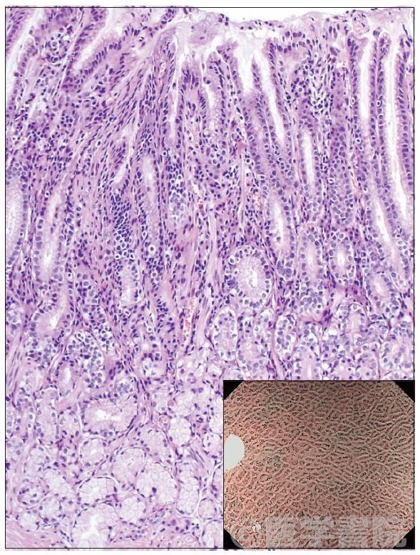 Fig. 4　幽門腺組織像とNBI 拡大像．