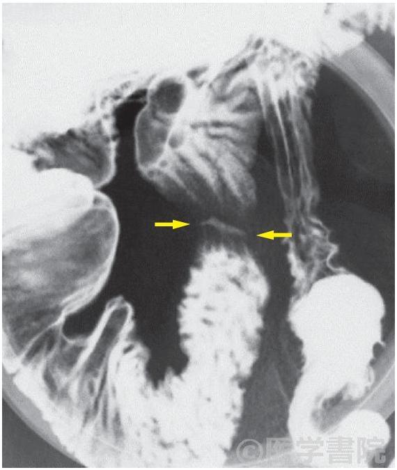Fig. 1　経口法圧迫像．NSAID 起因性小腸病変．幅の狭い輪状潰瘍（矢印）．