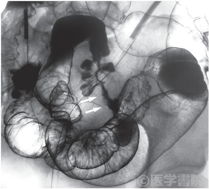 Fig. 2　Crohn 病．内視鏡的逆行性回腸造影（従来法）．回腸に長い狭窄（ → ）を認める．