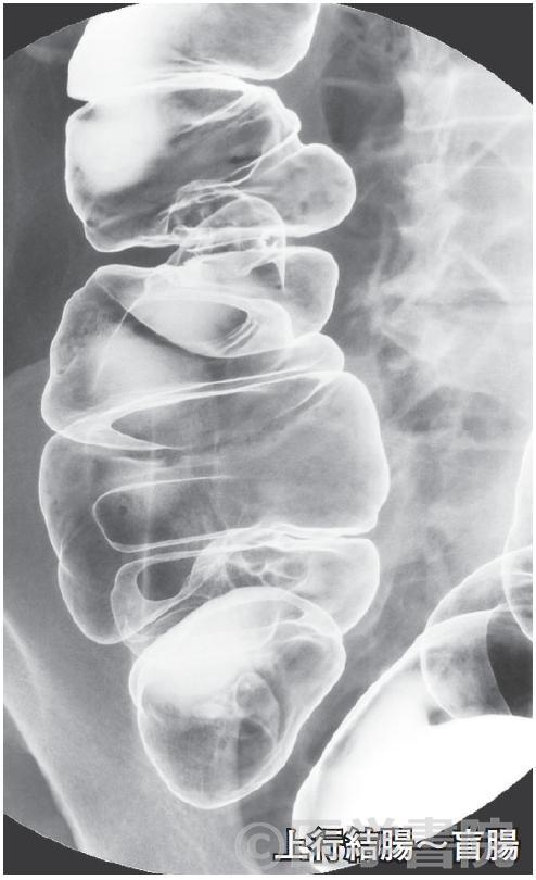 Fig. 3c　注腸X 線造影検査，脾彎曲～盲腸．右側横行結腸に移動したバリウムを体位変換で肛門側に移動させ，横行結腸から盲腸の二重造影像を撮影する（誌面の関係で掲載枚数は減らした）．