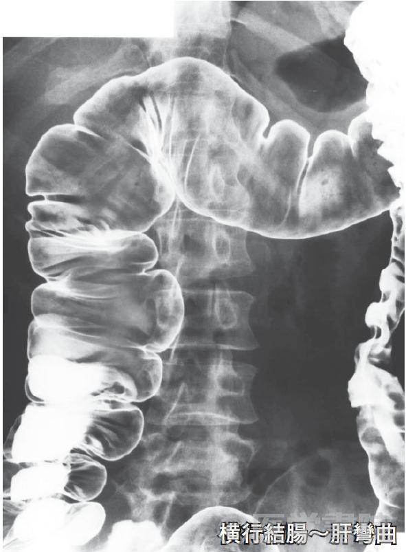 Fig. 3b　注腸X 線造影検査，脾彎曲～盲腸．右側横行結腸に移動したバリウムを体位変換で肛門側に移動させ，横行結腸から盲腸の二重造影像を撮影する（誌面の関係で掲載枚数は減らした）．