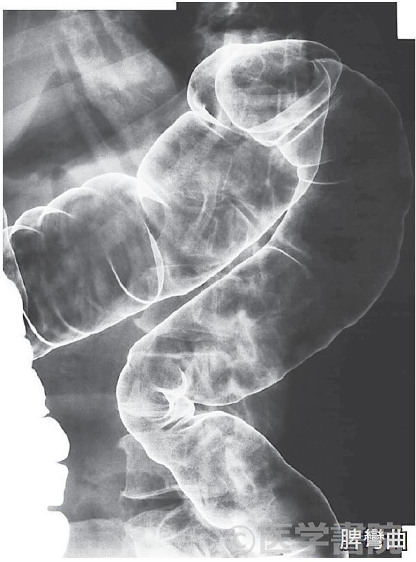 Fig. 3a  注腸X 線造影検査，脾彎曲～盲腸．右側横行結腸に移動したバリウムを体位変換で肛門側に移動させ，横行結腸から盲腸の二重造影像を撮影する（誌面の関係で掲載枚数は減らした）．