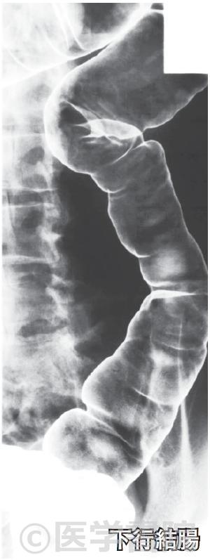 Fig. 2e　注腸X 線造影検査，直腸 / S 状結腸～下行結腸．さらに口側にバリウムを移動させ，二重造影像を撮影する．　　　　