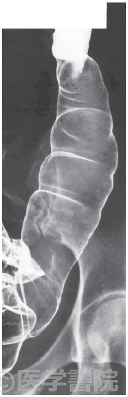 Fig. 2d　注腸X 線造影検査，直腸 / S 状結腸～下行結腸．さらに口側にバリウムを移動させ，二重造影像を撮影する．