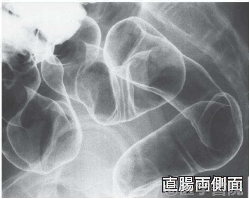 Fig. 2c 注腸X 線造影検査，直腸 / S 状結腸～下行結腸．さらに口側にバリウムを移動させ，二重造影像を撮影する．