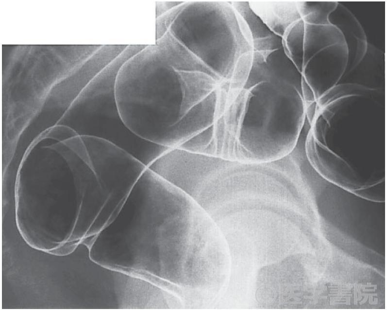 Fig. 2b　注腸X 線造影検査，直腸 / S 状結腸～下行結腸．さらに口側にバリウムを移動させ，二重造影像を撮影する．