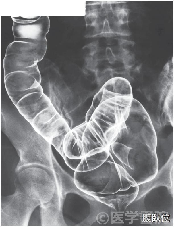 Fig. 2a　注腸X 線造影検査，直腸 / S 状結腸～下行結腸．さらに口側にバリウムを移動させ，二重造影像を撮影する．　