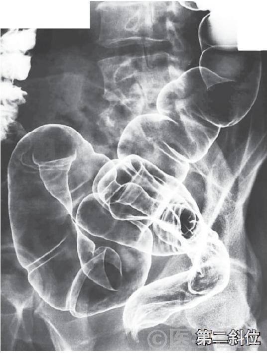 Fig. 1c　注腸X 線造影検査，直腸 / S 状結腸．体位変換でバリウムを口側に移動させ，二重造影像を心掛ける．