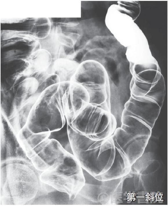 Fig. 1b 注腸X 線造影検査，直腸 / S 状結腸．体位変換でバリウムを口側に移動させ，二重造影像を心掛ける．