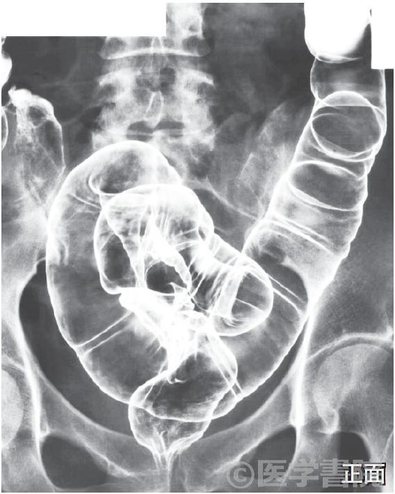 Fig. 1a　注腸X 線造影検査，直腸 / S 状結腸．体位変換でバリウムを口側に移動させ，二重造影像を心掛ける．