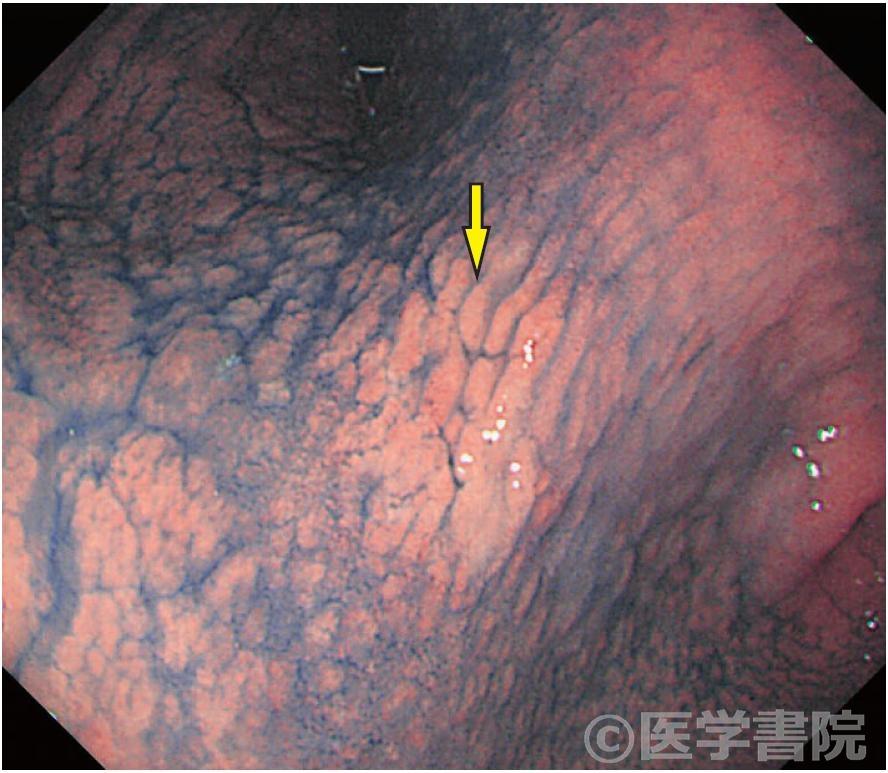 Fig. 2　経口内視鏡（Olympus GIF-Q260）での同じ病巣（矢印）の画像（Fig. 1 撮影後に1 個生検がなされた）