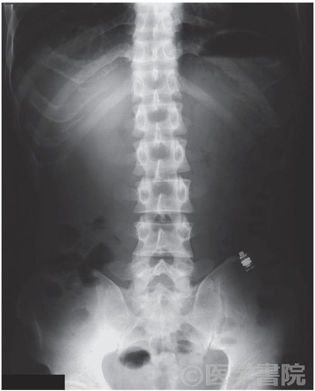 Fig.1　カプセル内視鏡滞留症例の腹部単純X 線像．左下腹部にカプセル内視鏡を認める．本症例は原因が不明の消化管出血精査目的で検査され，Crohn 病と診断された．滞留したカプセルは，後日ダブルバルーン内視鏡で回収した．