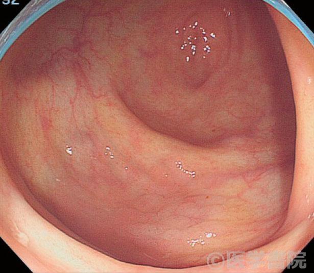Fig. 1a　盲腸のIIa（LST-G）病（a : 通常観察，b : インジゴカルミン撒布後）．