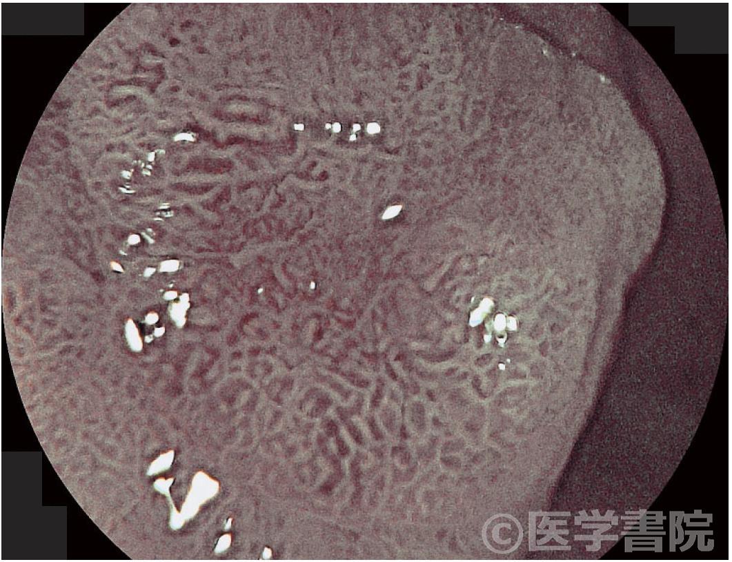 Fig. 1b　高分化型胃癌のFICE 観察像．