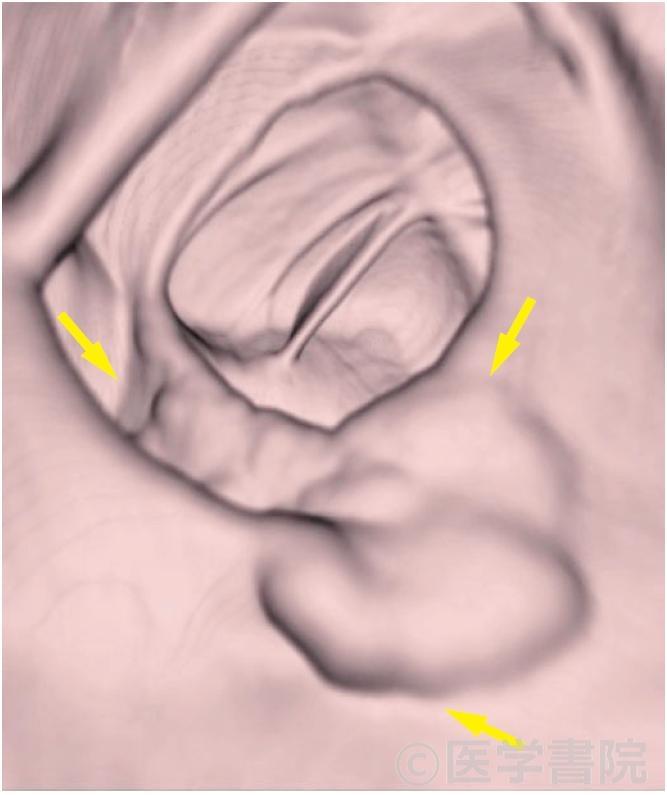 Fig. 1b　 a 病変のCT colo nography（VR 法）．病変は矢印で囲まれた部．