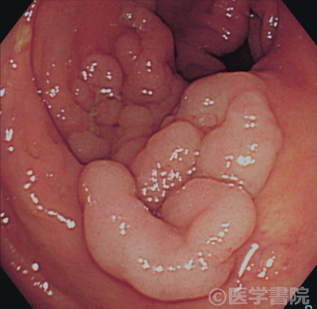 Fig. 1　結節集簇様病変（M 癌， 径65 mm 大）のvirtualcolonoscopy．　　　　　　　　　　　　　　　　　　　　　　　　　　　　     　Fig. 1a 大腸内視鏡像．