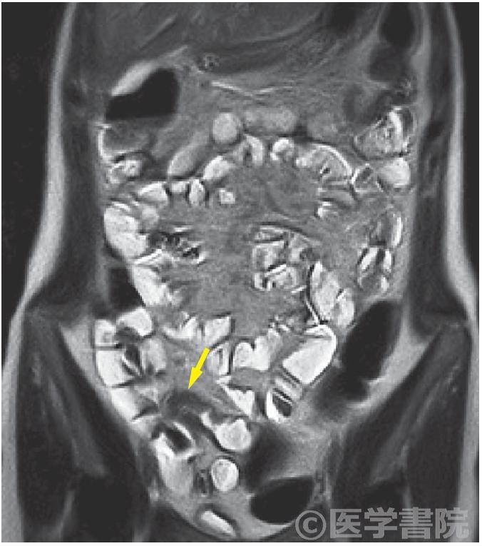 Fig. 2b　MREC での同病変SSFP 像（b）とT1 強調像（c）では，回腸末端に全周性の壁肥厚を伴うdeep mucosal lesion と診断される（矢印）．