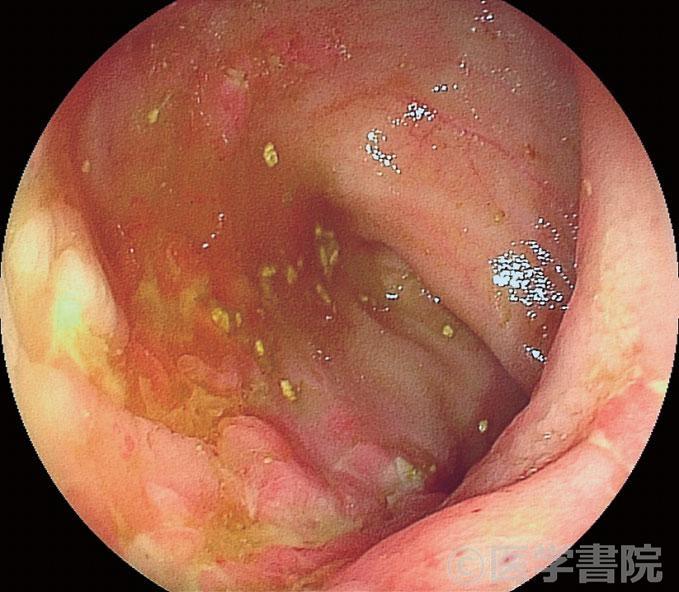 Fig. 2　Crohn 病症例のMREC 像．　　　　　　　　　　　　　　　　　　　　　　　　　Fig. 2a　回腸末端の下部消化管内視鏡像では縦走潰瘍と壁肥厚を認める．