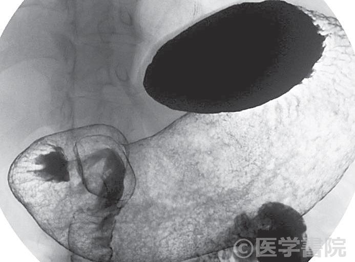 Fig. 1　萎縮性胃炎のX 線像．胃小区は大小不同がみられ，これをarea の不整という．