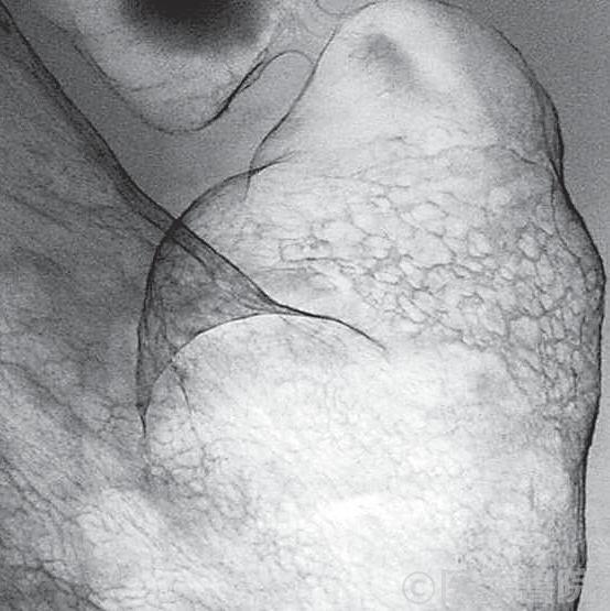 Fig. 1　0-IIc 型早期胃癌（未分化型）．前庭部前壁に，微細な不整を呈し，明瞭な境界を有する陥凹性病変を認める．陥凹内には大小不同の立ち上がりが急峻な結節が多数認められ，未分化型0-IIc の典型像である．陥凹の境界は，蚕が桑の葉を食べたあとの形態に似ている．
　　　　　　　　　　　　　　　　　　　　　　　　　　　　Fig. 1　a　 腹臥位第1 斜位X 線二重造影像．