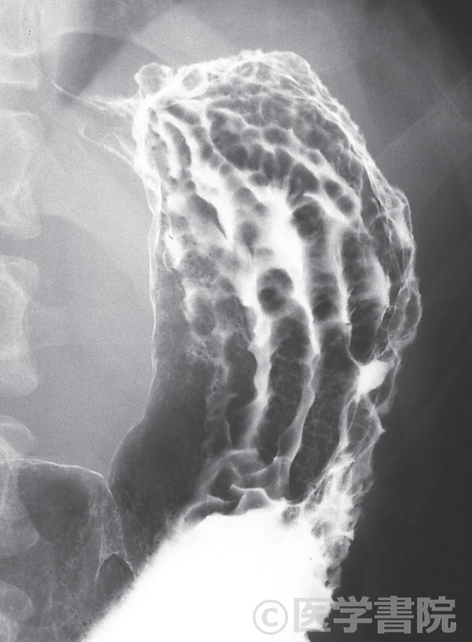 Fig. 1　スキルス型胃癌．
　　　　　　　　　　　　　　　　　　　　　　　　　　　　　　　　　Fig. 1a　 X 線像では胃体部にびまん性に巨大皺襞を認め，胃壁の伸展は不良である．