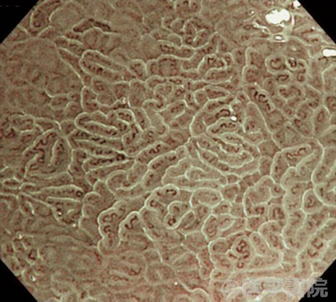 Fig. 1 a　胃体部の平坦型腸上皮化生のNBI 拡大画像．畝状～乳頭状の表面構造をもつ．
