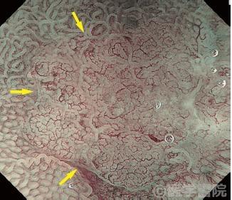 Fig. 2　0-IIc 型早期胃癌（未分化型癌）のNBI 併用拡大内視鏡像．内視鏡画像の上2 / 3 が癌粘膜である．背景粘膜の閉鎖性ループ状微小血管すなわちMV pattern は，同じ形態を保ったまま徐々に拡張し癌粘膜に移行している．背景粘膜の弧状の腺窩辺縁上皮すなわちMS pattern は，癌粘膜に移行しても，同じ形態を保ったままで
ある． したがって，MV pattern とMS patternに急峻な変化を認めないため，demarcation lineは同定できいと判定する．
〔武藤学，他．NBI 内視鏡アトラス．南江堂，p174，図5，2011 より転載〕