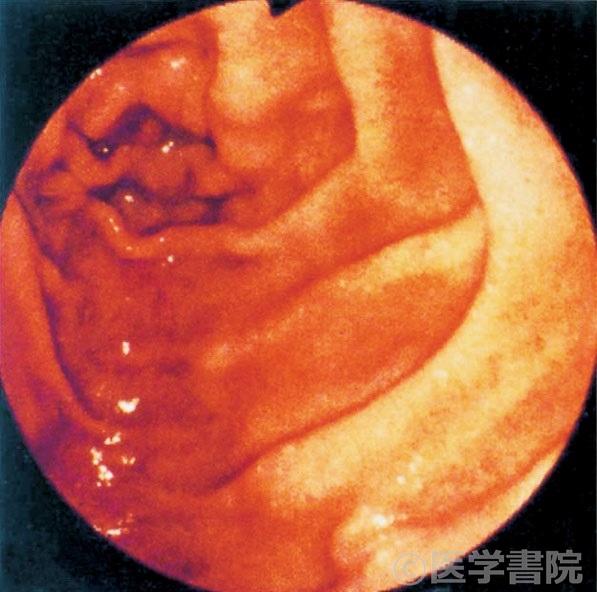 Fig. 1　腸リンパ管拡張症の白色絨毛（whitevilli）．びまん性あるいは皺襞主体の淡い白色調粘膜を示す．