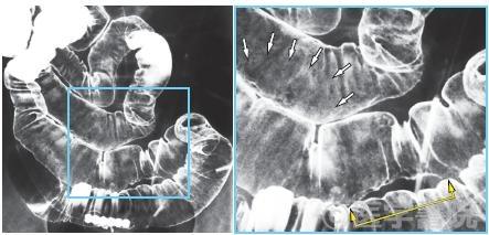 Fig. 1　Peyer 板のX 線造影所見．
　　　　　　　　　　　　　　　　　　　　　　　　　Fig. 1a（左）  内視鏡的逆行性回腸造影像．
　　　　　　　　　　　　　　　　　　　　　　　　　Fig.1b（右）   a の拡大像．腸間膜付着対側に，Kerckrig 皺襞の消失し，顆粒状を呈する領域と（矢印で囲まれた部位），側面変形領域（黄矢印 ）を認め，Peyer 板に相当する．