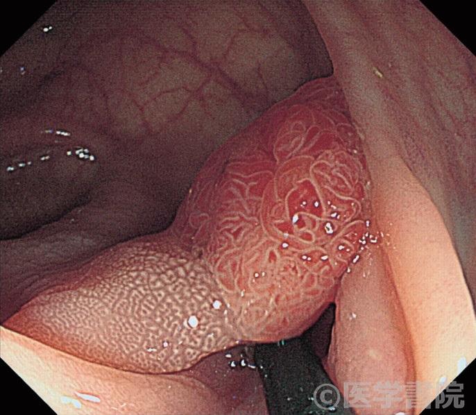 Fig. 1b 腺腫における白斑．隆起型．