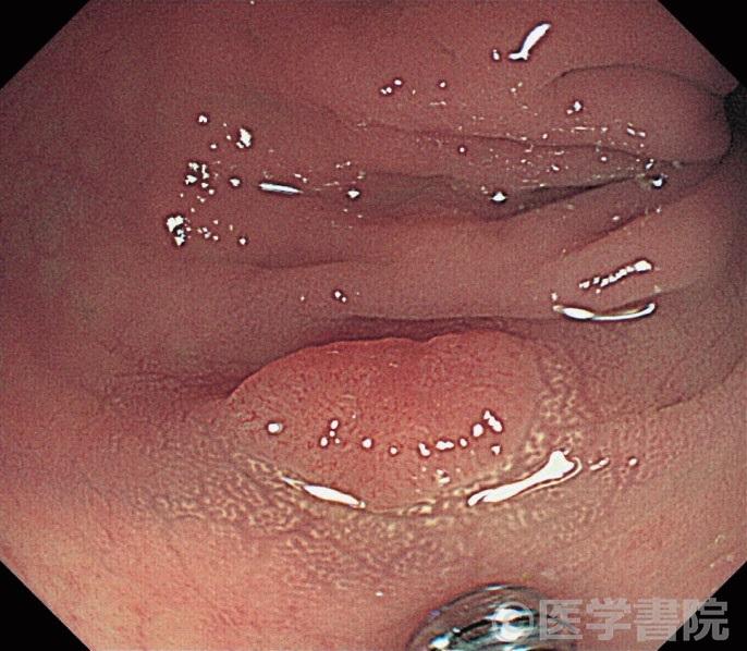  Fig. 1a 腺腫における白斑．表面型．