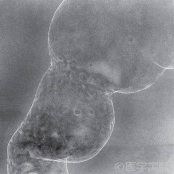 Fig. 1b  　腸結核（輪状配列する多発小潰瘍と萎縮瘢痕帯）． X 線像．