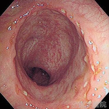 Fig. 1a　腸結核（輪状配列する多発小潰瘍と萎縮瘢痕帯）．内視鏡像.　