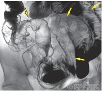 Fig. 1　Crohn 病小腸大腸型におけるskip lesion．回腸に縦走潰瘍瘢痕，軽度管腔狭小化と敷石像などの所見が正常腸管を介して認められる（矢印）．