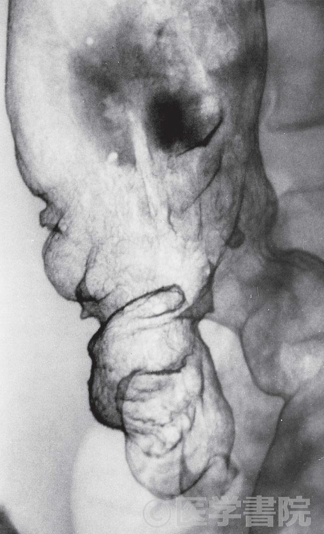 Fig. 1　X 線像．盲腸に腸壁の変形と偽憩室形成を認める．腸粘膜の網の目像が消失している．
